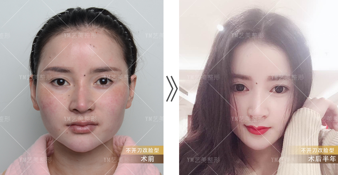  下颌角整形怎样规避风险
