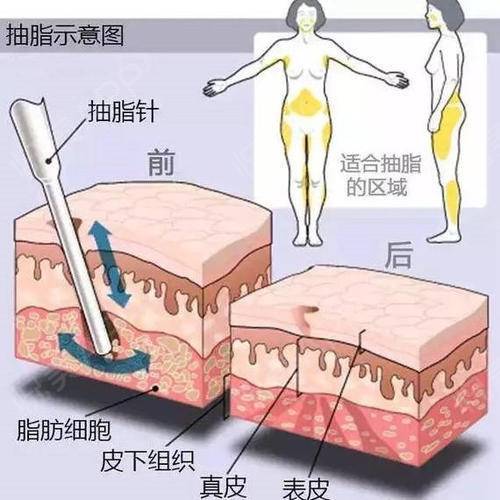 为何会有难看的吸脂术并发症