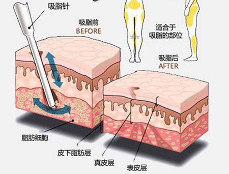 从几个问题带你正确了解吸脂术