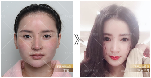 不开刀改下颌骨原理是什么，北京艺美王东不开刀改下颌骨技术怎么样