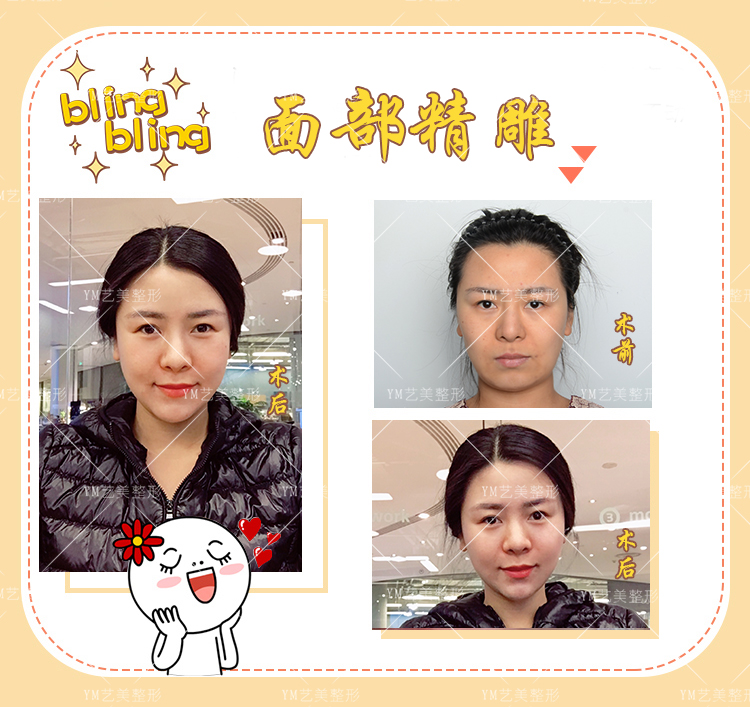 脸颊自体脂肪填充图片：这逆龄效果绝了！