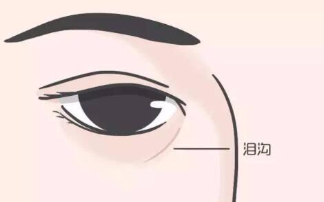 泪沟填充脂肪手术失败可以做修复手术