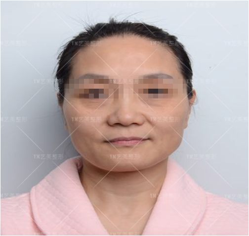 泪沟、眼窝凹陷、苹果肌下移、法令纹