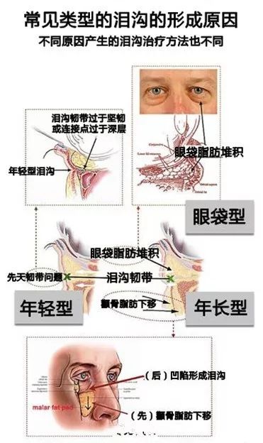 泪沟的不同类型