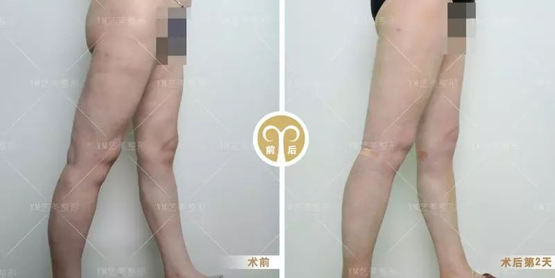 上图所示姑娘在别家做完吸脂后来找王东整形做修复的案例