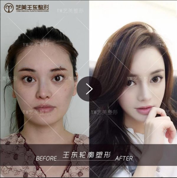 不开刀降颧骨