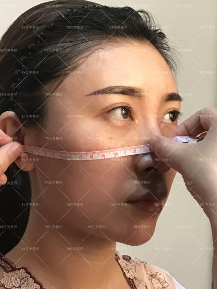 一针降颧骨颧弓手术，改变的可不只一点点