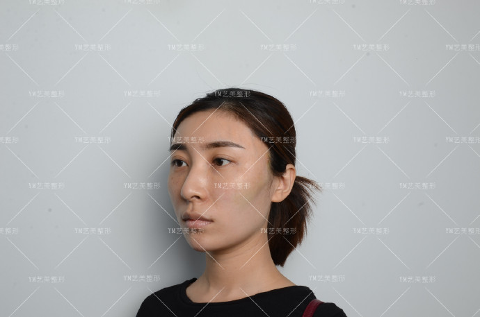 一针降颧骨颧弓术后效果