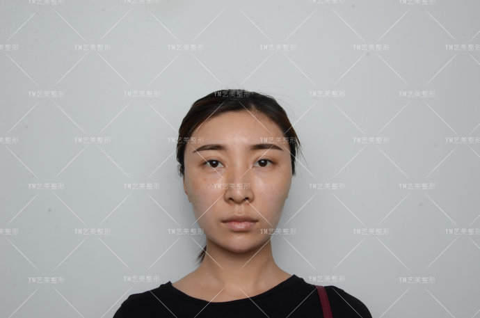 一针降颧骨颧弓术后效果对比