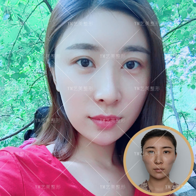 一针降颧骨颧弓