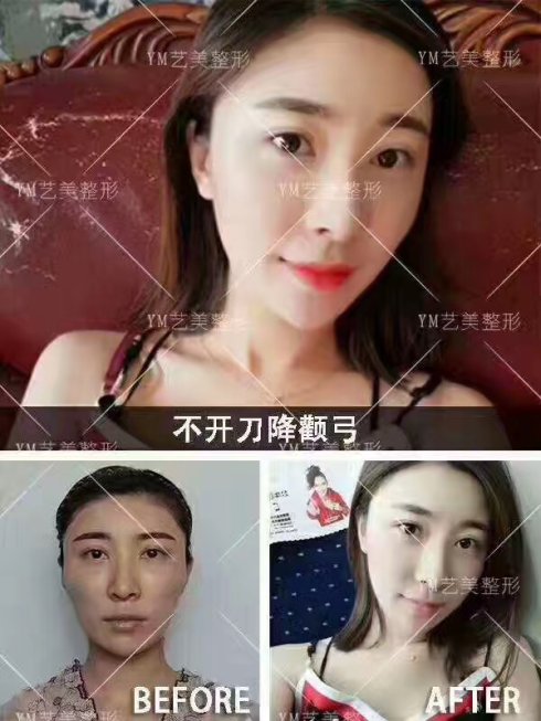 一针降颧骨颧弓，彻底改变生活