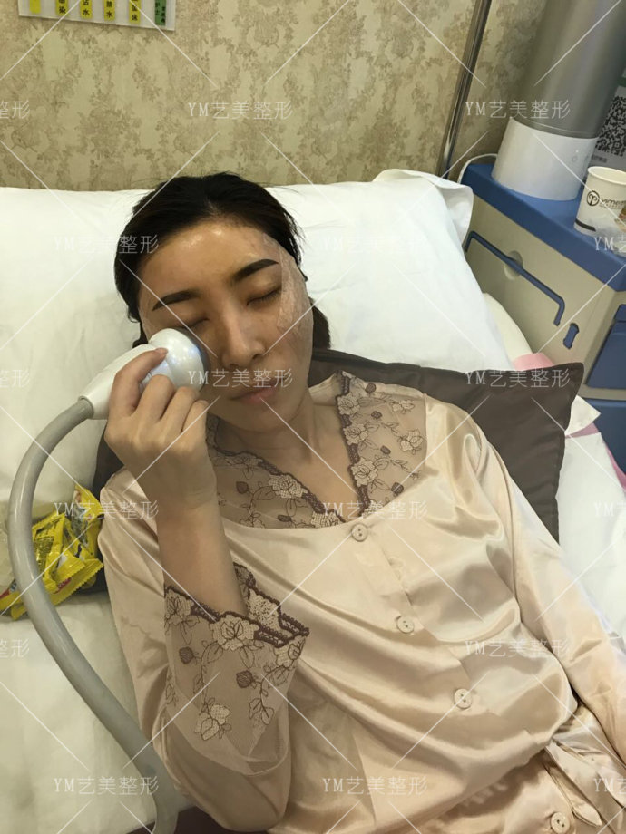 一针降颧骨颧弓求美者术后