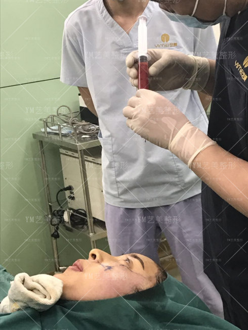 一针降颧骨颧弓手术结束