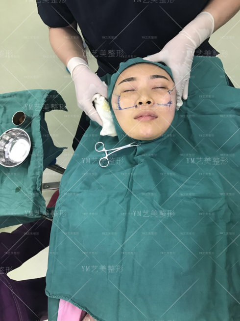 一针降颧骨颧弓手术开始