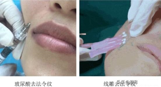 祛除法令纹的方法