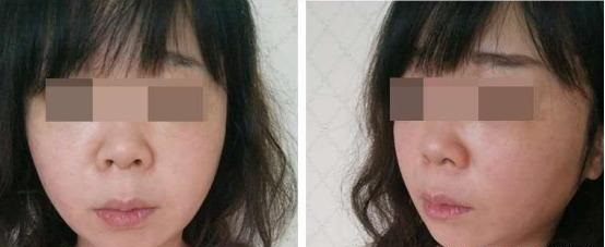 鼻子两侧的法令纹，让我显老好几岁...怎样才能"大妈"变"少女"?