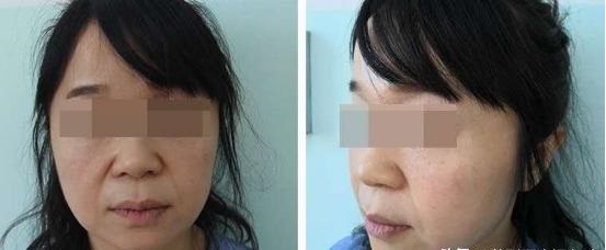 鼻子两侧的法令纹，让我显老好几岁...怎样才能"大妈"变"少女"?