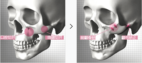颧骨手术的优势