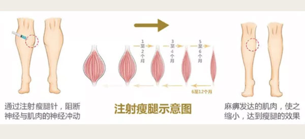注射瘦腿针注意事项!