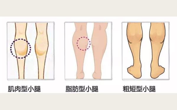 哪些人适合注射瘦腿针？