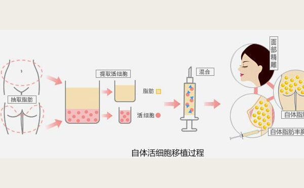 自体脂肪填充原理！