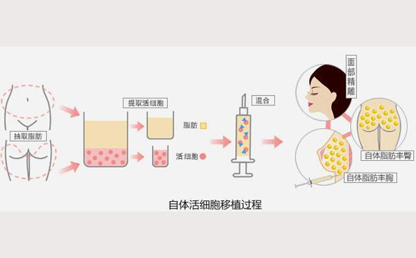 自体脂肪填充原理