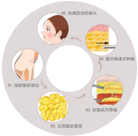 额头重塑术