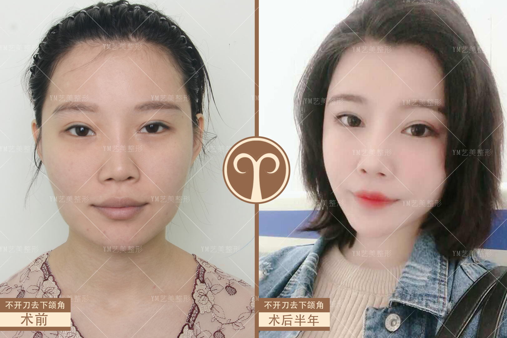 不开刀下颌骨手术效果