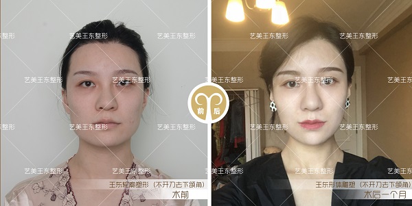 艺美不开刀去下颌角