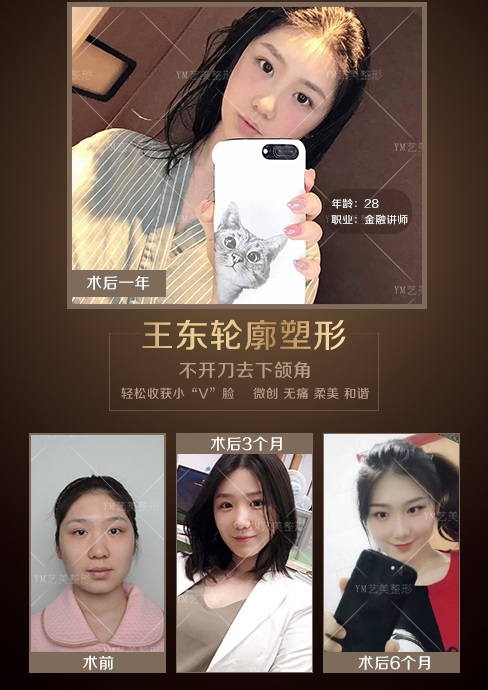  不开刀改下颌骨原理