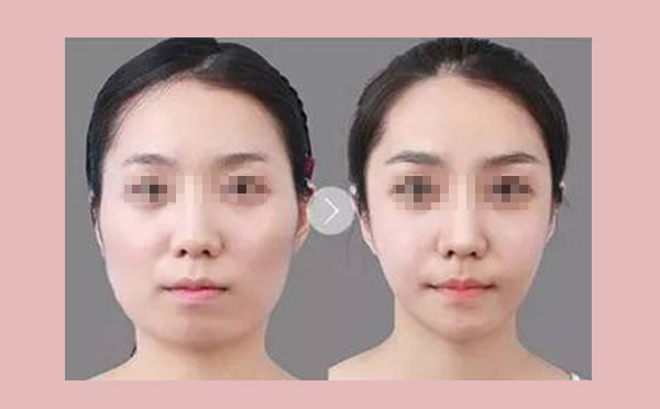 自体脂肪面颊的作用还能维持多久?
