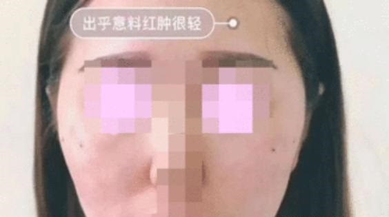 面部埋线提升"即刻效果不错"，40岁左右的请"另辟蹊径"...