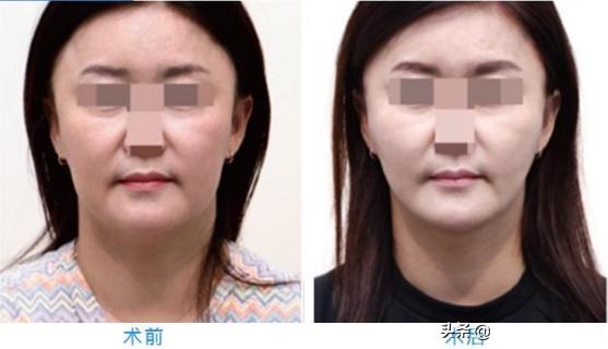面部埋线提升"即刻效果不错"，40岁左右的请"另辟蹊径"...