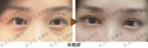 王东自体脂肪移植祛眼袋