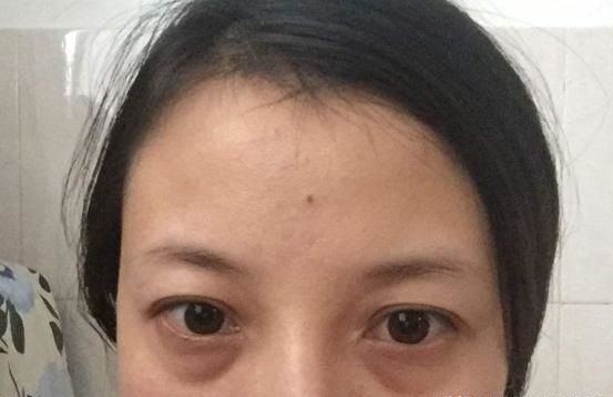 成年人的眼袋
