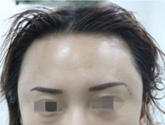 做了额头脂肪填充，感觉填多了，什么时候可以取出?