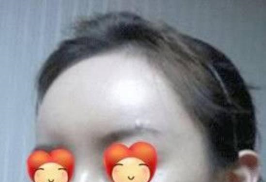 做了额头脂肪填充，感觉填多了，什么时候可以取出?
