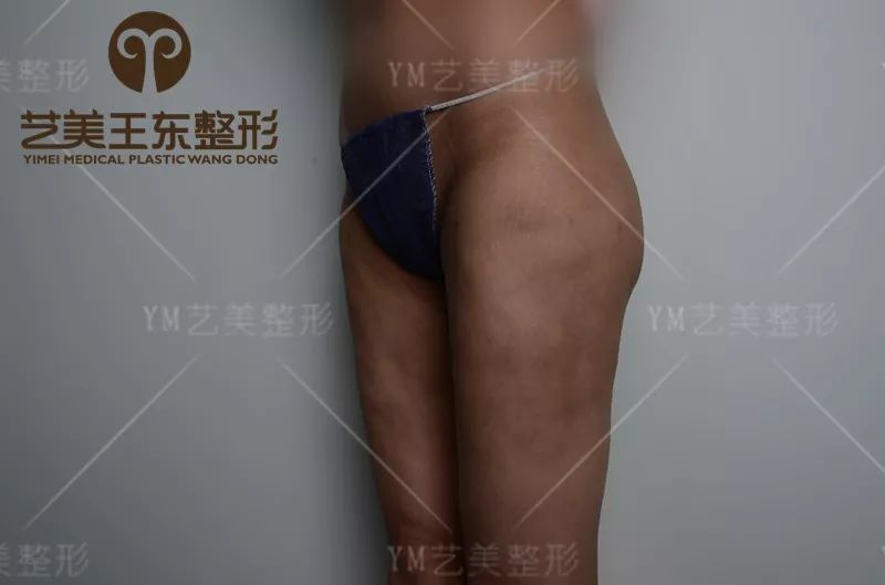 大腿吸脂失败修复手术