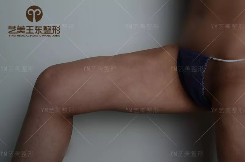 吸脂失败修复手术