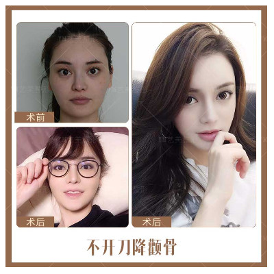 艺美王东不开刀降颧骨效果