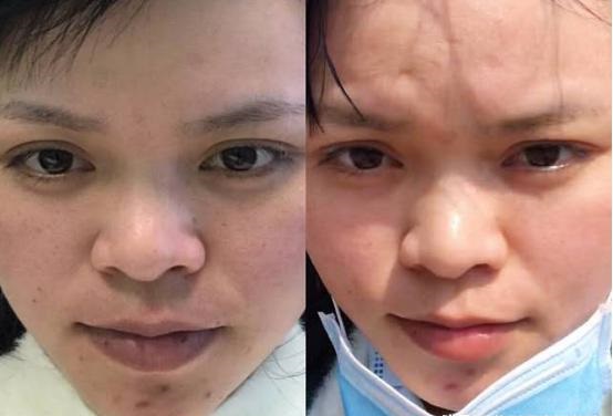 水光针需要经常打吗？