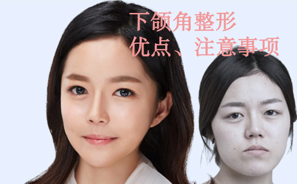 下颌角整形优点和注意事项