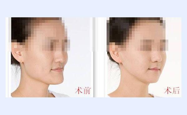 下颌角整形效果