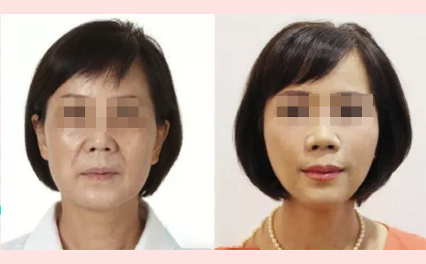 下颌角整形效果