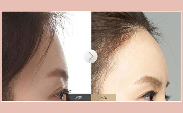 在做完丰额头之后可能会有哪些后遗症呢?