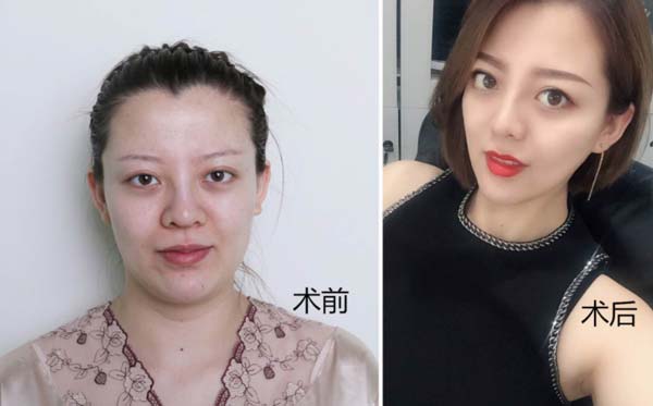 下颌角手术怎么样