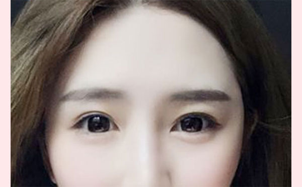 自体脂肪丰额头的适应人群有哪些?