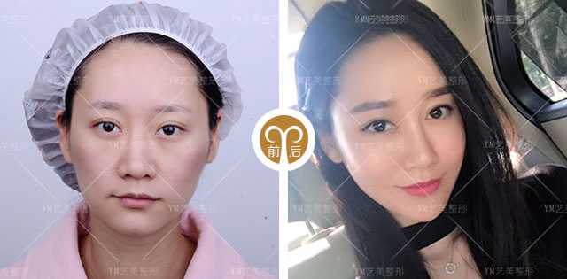 下颌角整形的效果