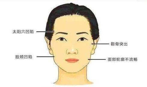 太阳穴填充自体脂肪好不好?效果持久吗?