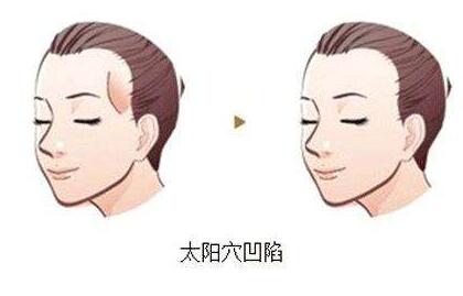 太阳穴填充自体脂肪好不好?效果持久吗?